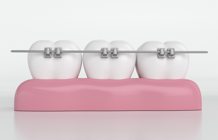 矯正装置の装着・調整