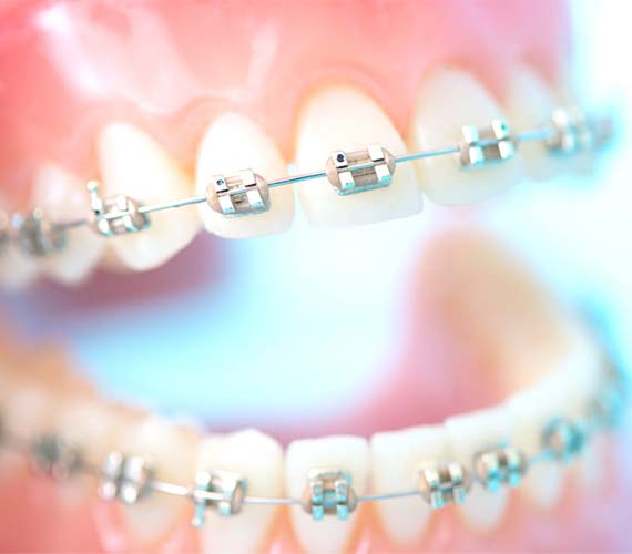 矯正歯科・小児矯正